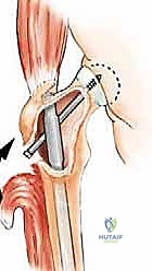 صورة توضيحية لـ إدارة نقائل العظم الفخذي جراحياً: دليل شامل للمرضى مع الأستاذ الدكتور محمد هطيف في صنعاء