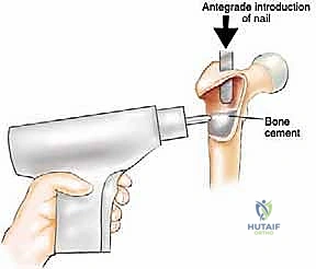 صورة توضيحية لـ إدارة نقائل العظم الفخذي جراحياً: دليل شامل للمرضى مع الأستاذ الدكتور محمد هطيف في صنعاء