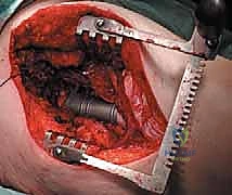 صورة طبية: إدارة نقائل العظم الفخذي جراحياً: دليل شامل للمرضى مع الأستاذ الدكتور محمد هطيف في صنعاء