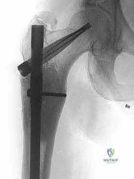 صورة طبية: إدارة نقائل العظم الفخذي جراحياً: دليل شامل للمرضى مع الأستاذ الدكتور محمد هطيف في صنعاء