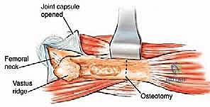 إدارة نقائل العظم الفخذي جراحياً