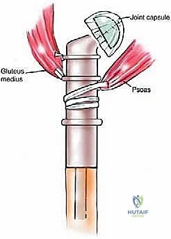 صورة طبية: إدارة نقائل العظم الفخذي جراحياً: دليل شامل للمرضى مع الأستاذ الدكتور محمد هطيف في صنعاء