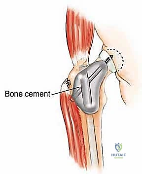 صورة طبية: إدارة نقائل العظم الفخذي جراحياً: دليل شامل للمرضى مع الأستاذ الدكتور محمد هطيف في صنعاء