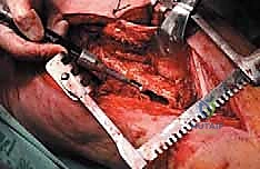 صورة طبية: إدارة نقائل العظم الفخذي جراحياً: دليل شامل للمرضى مع الأستاذ الدكتور محمد هطيف في صنعاء