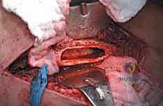 صورة طبية: إدارة نقائل العظم الفخذي جراحياً: دليل شامل للمرضى مع الأستاذ الدكتور محمد هطيف في صنعاء