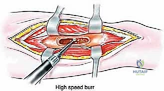 صورة طبية: إدارة نقائل العظم الفخذي جراحياً: دليل شامل للمرضى مع الأستاذ الدكتور محمد هطيف في صنعاء