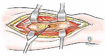 أعراض نقائل العظام السريرية