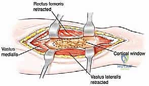 تخطيط جراحي دقيق لأورام العظام