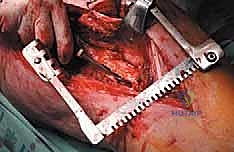 صورة طبية: إدارة نقائل العظم الفخذي جراحياً: دليل شامل للمرضى مع الأستاذ الدكتور محمد هطيف في صنعاء