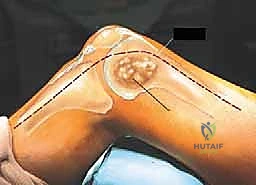 صورة طبية: إدارة نقائل العظم الفخذي جراحياً: دليل شامل للمرضى مع الأستاذ الدكتور محمد هطيف في صنعاء