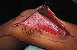 صورة طبية: إدارة نقائل العظم الفخذي جراحياً: دليل شامل للمرضى مع الأستاذ الدكتور محمد هطيف في صنعاء