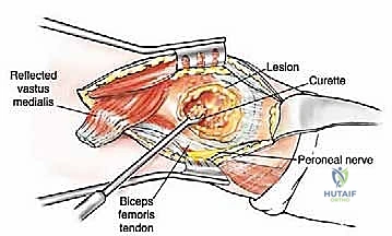 صورة طبية: إدارة نقائل العظم الفخذي جراحياً: دليل شامل للمرضى مع الأستاذ الدكتور محمد هطيف في صنعاء