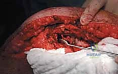 صورة طبية: إدارة نقائل العظم الفخذي جراحياً: دليل شامل للمرضى مع الأستاذ الدكتور محمد هطيف في صنعاء