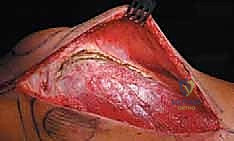 صورة طبية: إدارة نقائل العظم الفخذي جراحياً: دليل شامل للمرضى مع الأستاذ الدكتور محمد هطيف في صنعاء