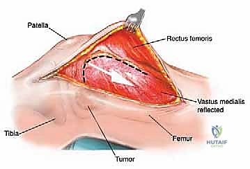 صورة طبية: إدارة نقائل العظم الفخذي جراحياً: دليل شامل للمرضى مع الأستاذ الدكتور محمد هطيف في صنعاء