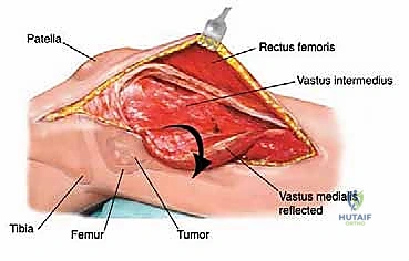 صورة طبية: إدارة نقائل العظم الفخذي جراحياً: دليل شامل للمرضى مع الأستاذ الدكتور محمد هطيف في صنعاء
