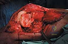 صورة طبية: إدارة نقائل العظم الفخذي جراحياً: دليل شامل للمرضى مع الأستاذ الدكتور محمد هطيف في صنعاء