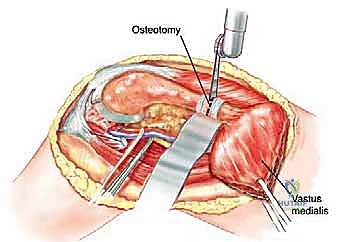 صورة طبية: إدارة نقائل العظم الفخذي جراحياً: دليل شامل للمرضى مع الأستاذ الدكتور محمد هطيف في صنعاء