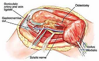 صورة طبية: إدارة نقائل العظم الفخذي جراحياً: دليل شامل للمرضى مع الأستاذ الدكتور محمد هطيف في صنعاء