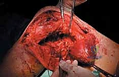 صورة طبية: إدارة نقائل العظم الفخذي جراحياً: دليل شامل للمرضى مع الأستاذ الدكتور محمد هطيف في صنعاء