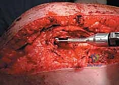 صورة طبية: إدارة نقائل العظم الفخذي جراحياً: دليل شامل للمرضى مع الأستاذ الدكتور محمد هطيف في صنعاء