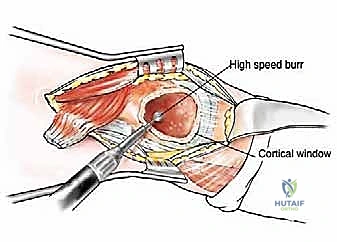 صورة طبية: إدارة نقائل العظم الفخذي جراحياً: دليل شامل للمرضى مع الأستاذ الدكتور محمد هطيف في صنعاء