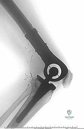 صورة طبية: إدارة نقائل العظم الفخذي جراحياً: دليل شامل للمرضى مع الأستاذ الدكتور محمد هطيف في صنعاء