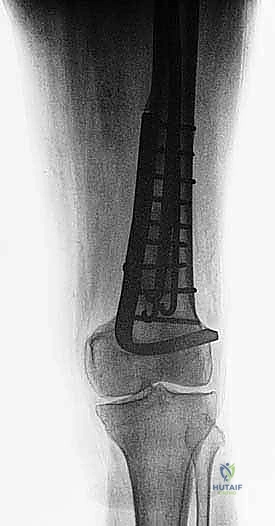 صورة طبية: إدارة نقائل العظم الفخذي جراحياً: دليل شامل للمرضى مع الأستاذ الدكتور محمد هطيف في صنعاء