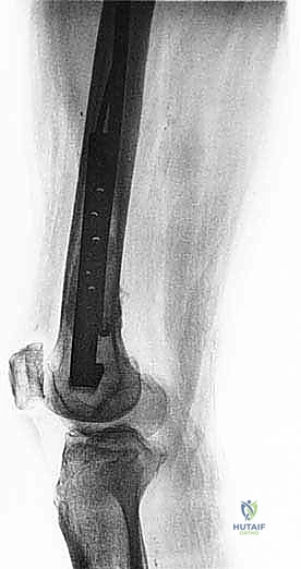 صورة طبية: إدارة نقائل العظم الفخذي جراحياً: دليل شامل للمرضى مع الأستاذ الدكتور محمد هطيف في صنعاء