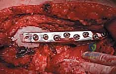 صورة طبية: إدارة نقائل العظم الفخذي جراحياً: دليل شامل للمرضى مع الأستاذ الدكتور محمد هطيف في صنعاء