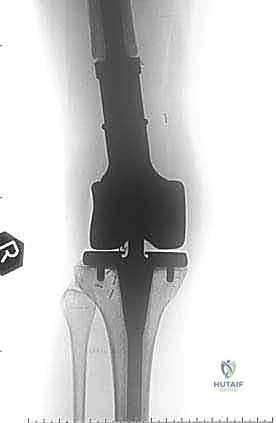 صورة طبية: إدارة نقائل العظم الفخذي جراحياً: دليل شامل للمرضى مع الأستاذ الدكتور محمد هطيف في صنعاء