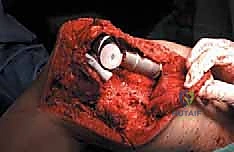 صورة طبية: إدارة نقائل العظم الفخذي جراحياً: دليل شامل للمرضى مع الأستاذ الدكتور محمد هطيف في صنعاء