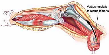 صورة طبية: إدارة نقائل العظم الفخذي جراحياً: دليل شامل للمرضى مع الأستاذ الدكتور محمد هطيف في صنعاء