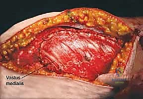 صورة طبية: إدارة نقائل العظم الفخذي جراحياً: دليل شامل للمرضى مع الأستاذ الدكتور محمد هطيف في صنعاء