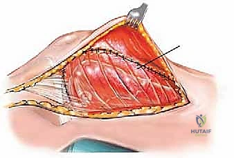 صورة طبية: إدارة نقائل العظم الفخذي جراحياً: دليل شامل للمرضى مع الأستاذ الدكتور محمد هطيف في صنعاء