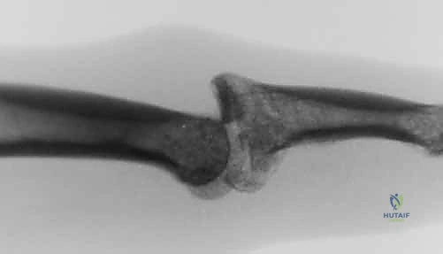 آليات حدوث الكسر الخلعي في مفصل PIP