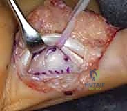 تثبيت الصفيحة الراحية في الخندق العظمي