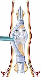 التشخيص بالأشعة السينية لكسر خلع مفصل PIP