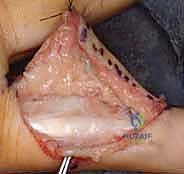 المبدأ العلمي لعملية رأب المفصل بالصفيحة الراحية