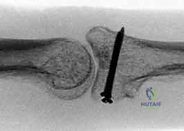 Surgical technique step for Hemi-Hamate Autograft Reconstruction of Unstable Dorsal Proximal Interphalangeal Joint Fracture-Dislocations