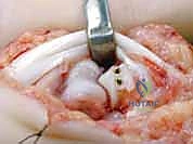 Hemi-Hamate Autograft Reconstruction for Unstable PIP Dorsal Fracture-Dislocations