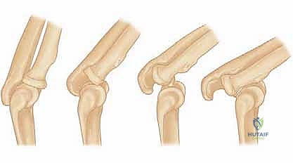 Illustration of repair or reconstruction - Dr. Mohammed Hutaif