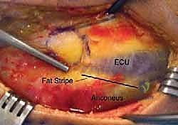 آلية السقوط على يد ممدودة وتأثيرها على الكوع