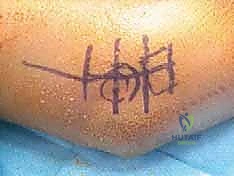 تشريح مفصل الكوع والأربطة الجانبية