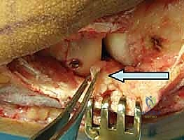 مقارنة بين العلاجات المختلفة للكوع