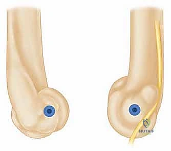 خلع الكوع البسيط وإصلاح الرباط الجانبي الزندي الوحشي: دليل شامل للعلاج والتعافي