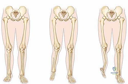 وصف طبي دقيق للمريض وقصر الطرف