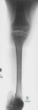 صورة طبية: عمليات بتر سيم وبويد الدقيقة لعلاج نقص عظم الشظية الخلقي: دليل شامل للمرضى