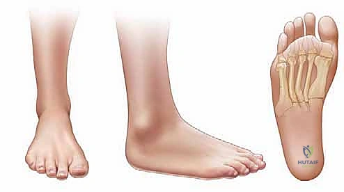 تثبيت العظام في عملية بويد