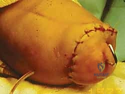 صورة طبية: عمليات بتر سيم وبويد الدقيقة لعلاج نقص عظم الشظية الخلقي: دليل شامل للمرضى